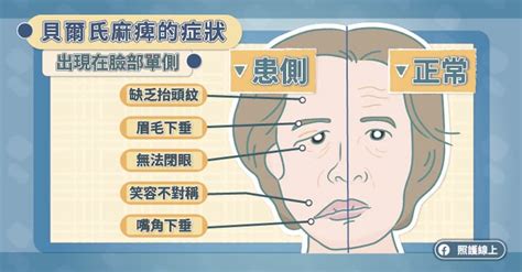 就算只有舌頭能動|臉歪嘴斜，不一定是中風－顏面神經麻痺（懶人包） 